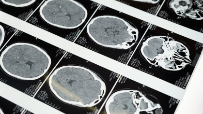 Rutgers-Newark Neuroscientist Devises Test to Catch Alzheimer's Symptoms Early